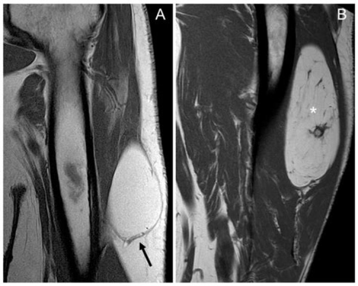 Can a lipoma be deep?