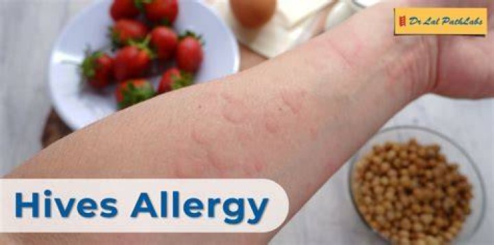 Can you get hives from too much sugar?