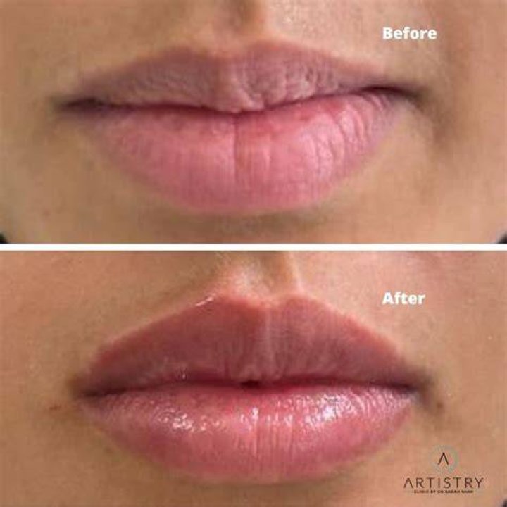 What can I do after lip fillers?